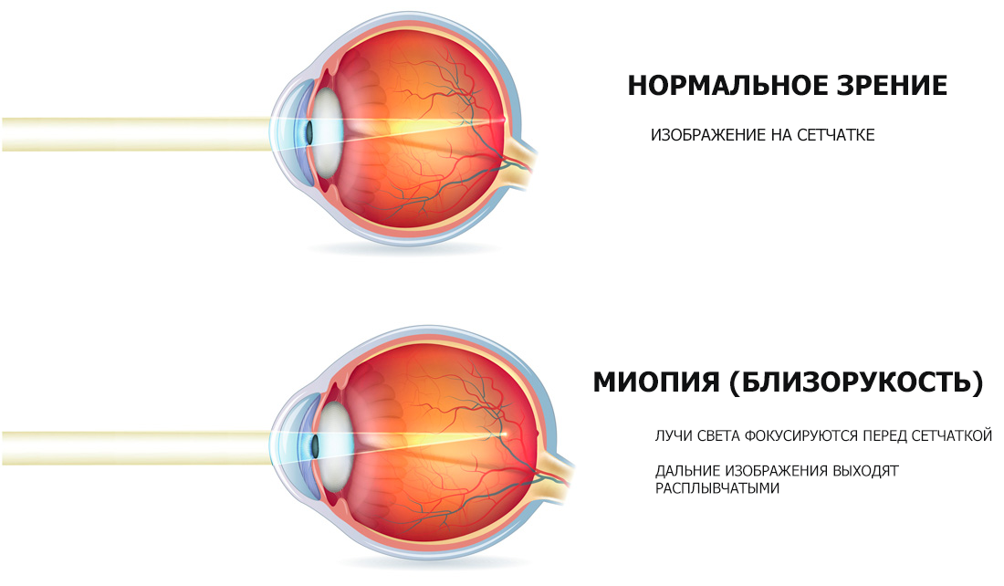 Лечение миопии в домашних условиях: эффективные методы и упражнения