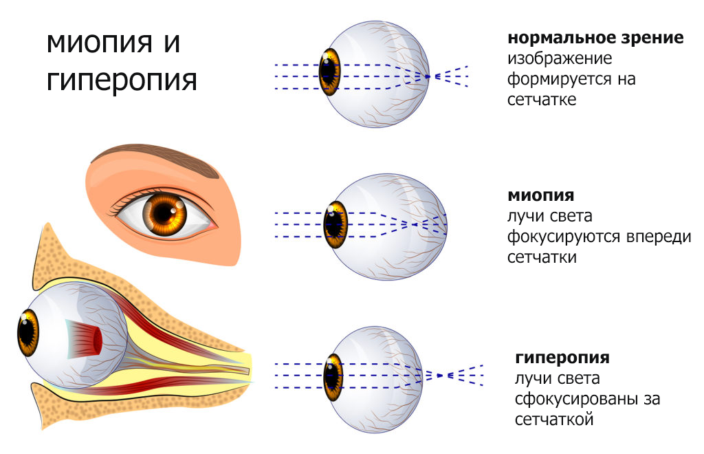 миопия и гиперопия