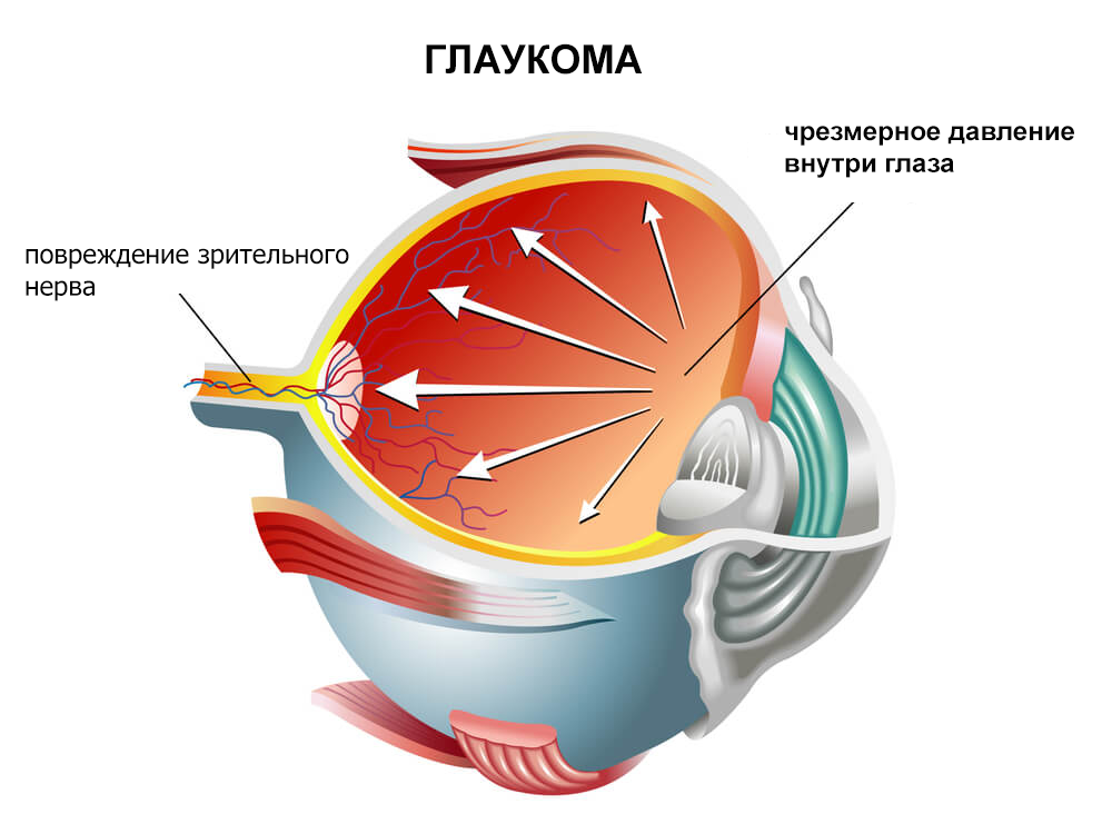 что такое глаукома