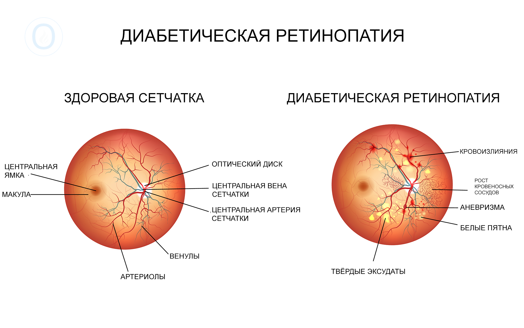 диабетическая