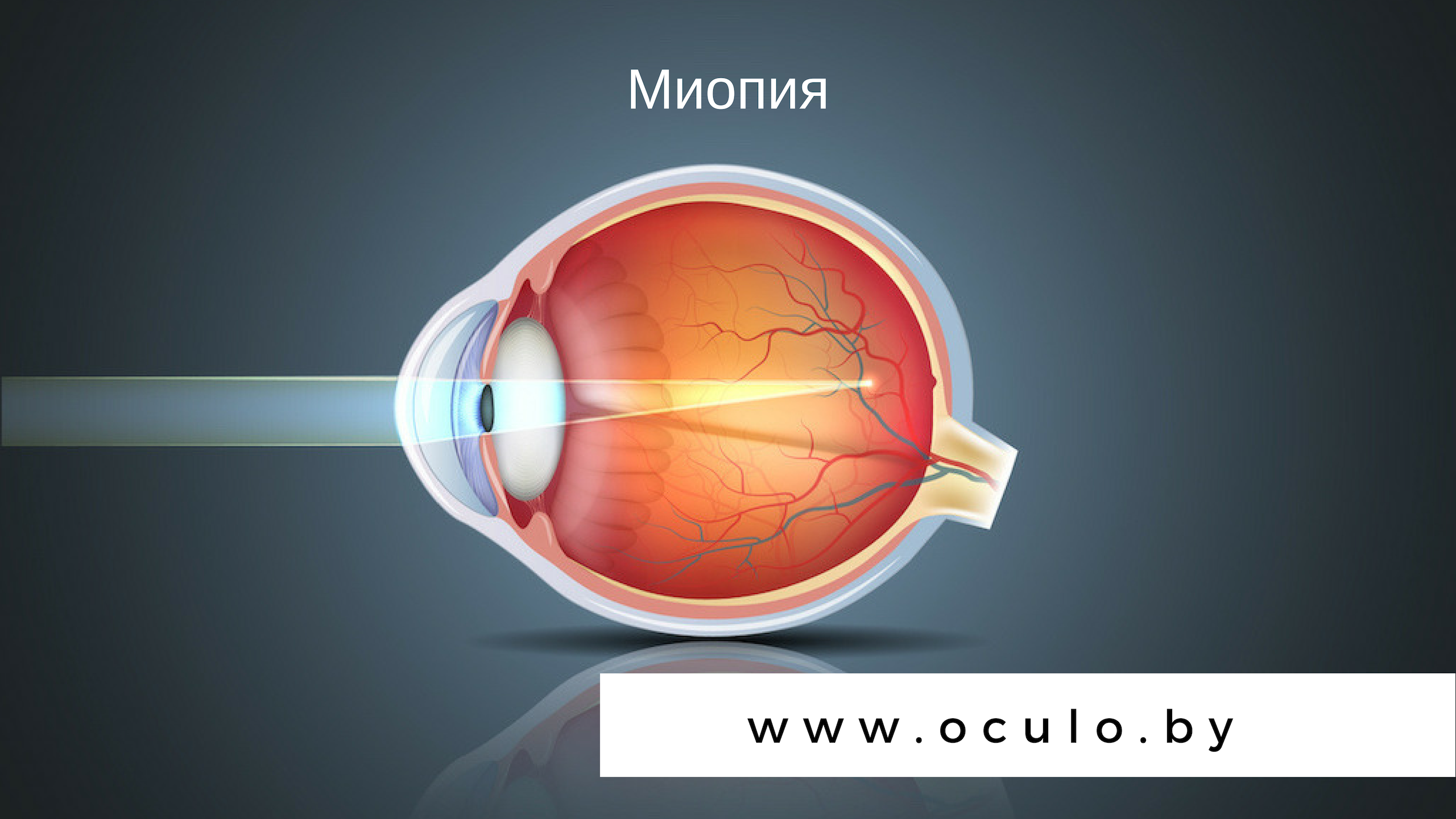 Миопия (Близорукость): причины, симптомы, лечение.