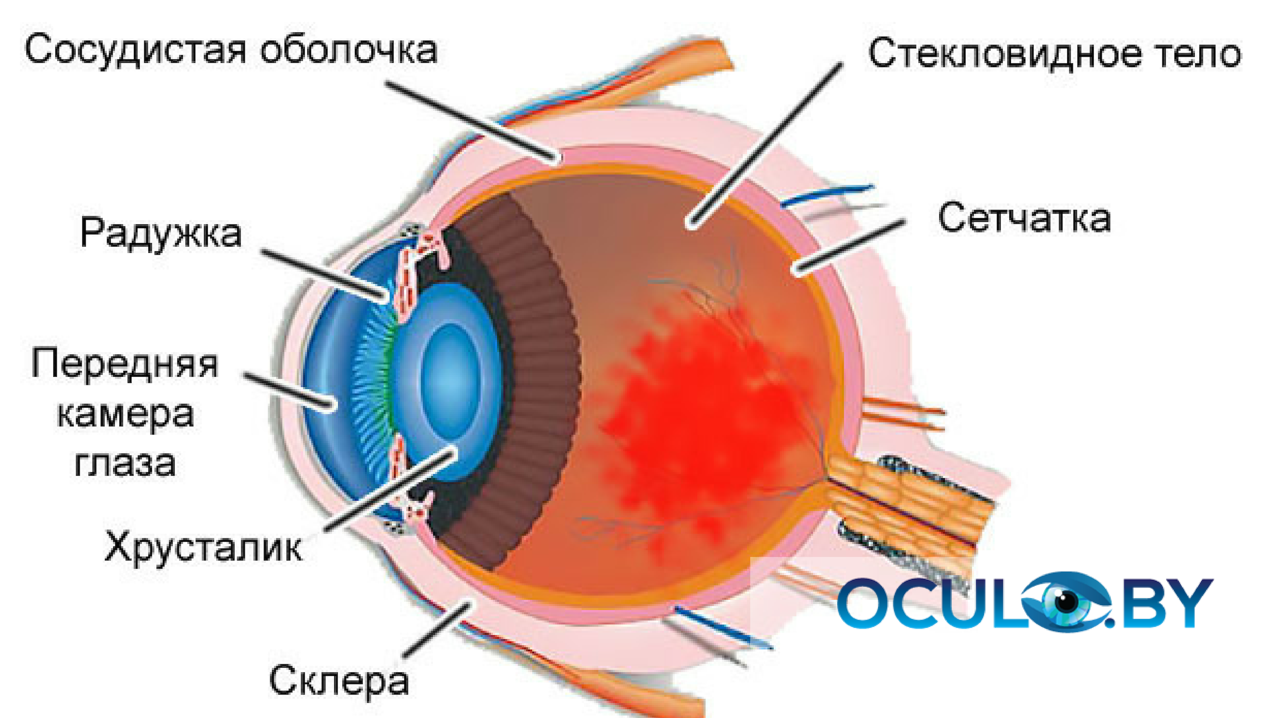 гемофтальм