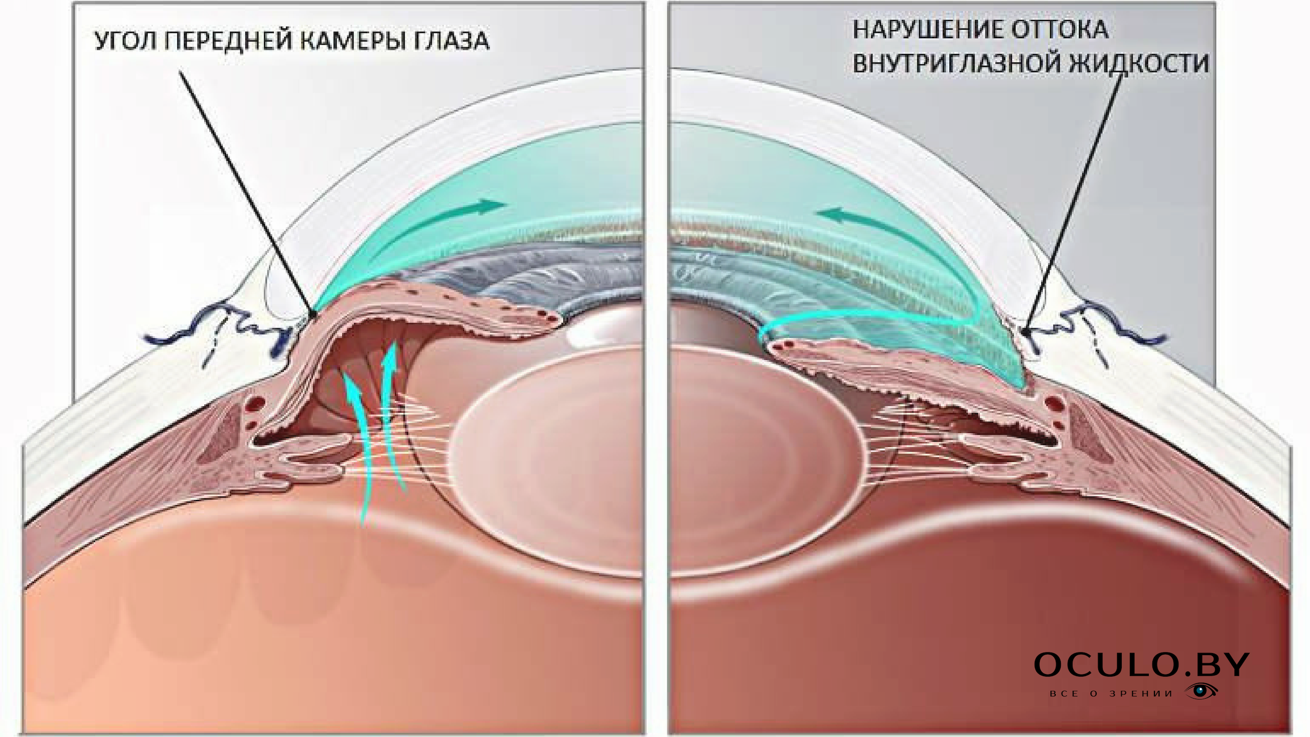 Механизм оттока внутриглазной жидкости. Лазерная десцеметогониопунктура. Схема оттока внутриглазной жидкости. Закрытоугольная глаукома глаза.